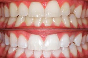 Preguntas frecuentes blanqueamiento dental