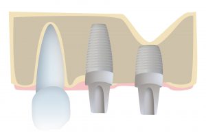 Implantes dentales cortos