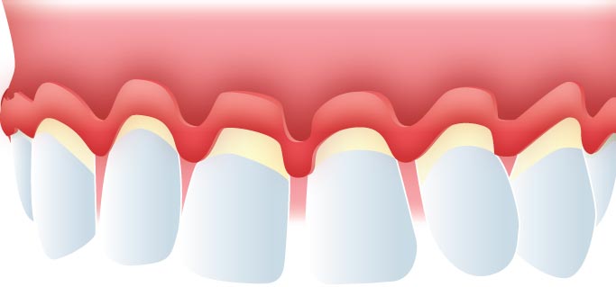 Raspado y alisado radicular periodontitis